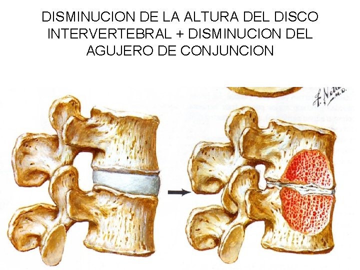 DISMINUCION DE LA ALTURA DEL DISCO INTERVERTEBRAL + DISMINUCION DEL AGUJERO DE CONJUNCION 