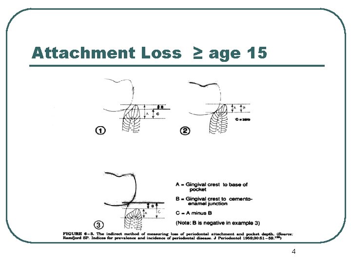 Attachment Loss ≥ age 15 4 