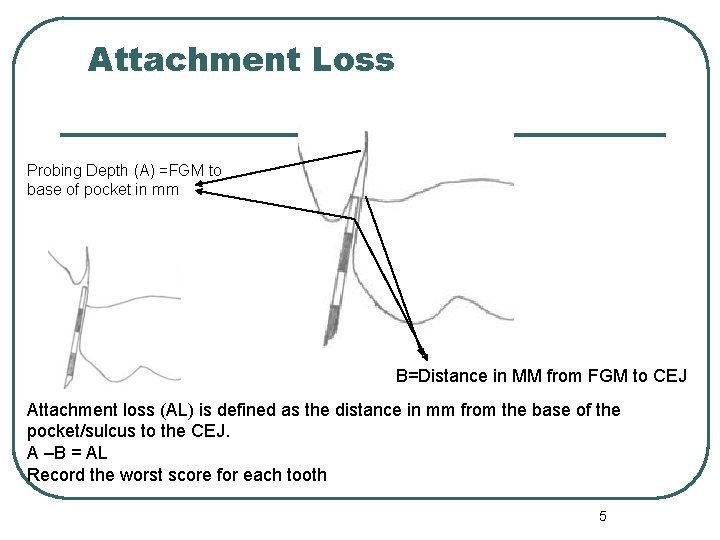 Attachment Loss Probing Depth (A) =FGM to base of pocket in mm B=Distance in