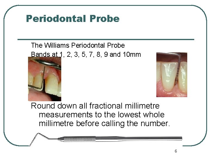 Periodontal Probe The Williams Periodontal Probe Bands at 1, 2, 3, 5, 7, 8,