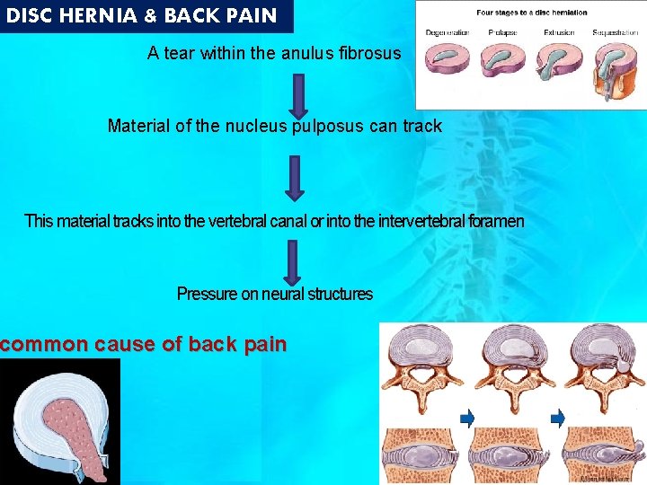 DISC HERNIA & BACK PAIN A tear within the anulus fibrosus Material of the