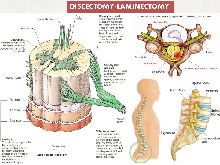 DISCECTOMY/LAMINECTOMY. A prolapsed intervertebral disc may impinge upon meningeal sac spinal cord most commonly