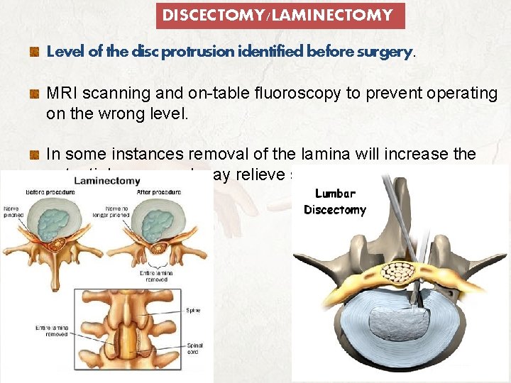 DISCECTOMY/LAMINECTOMY Level of the disc protrusion identified before surgery. MRI scanning and on-table fluoroscopy