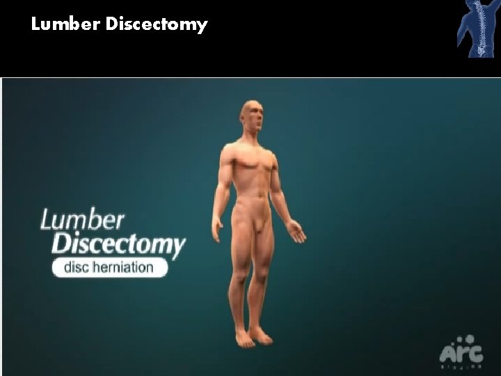 Lumber Discectomy 53 