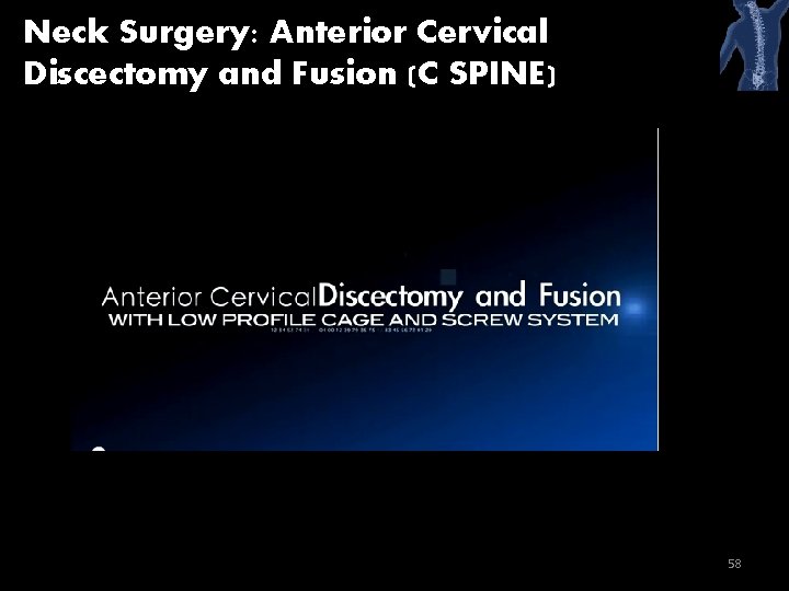 Neck Surgery: Anterior Cervical Discectomy and Fusion (C SPINE) 58 