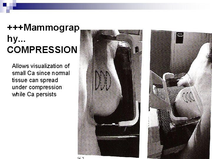 +++Mammograp hy. . . COMPRESSION Allows visualization of small Ca since normal tissue can