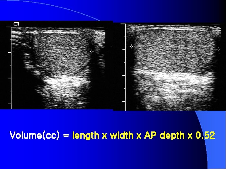 Volume(cc) = length x width x AP depth x 0. 52 