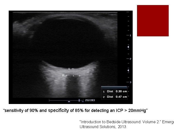 “sensitivity of 90% and specificity of 85% for detecting an ICP > 20 mm.