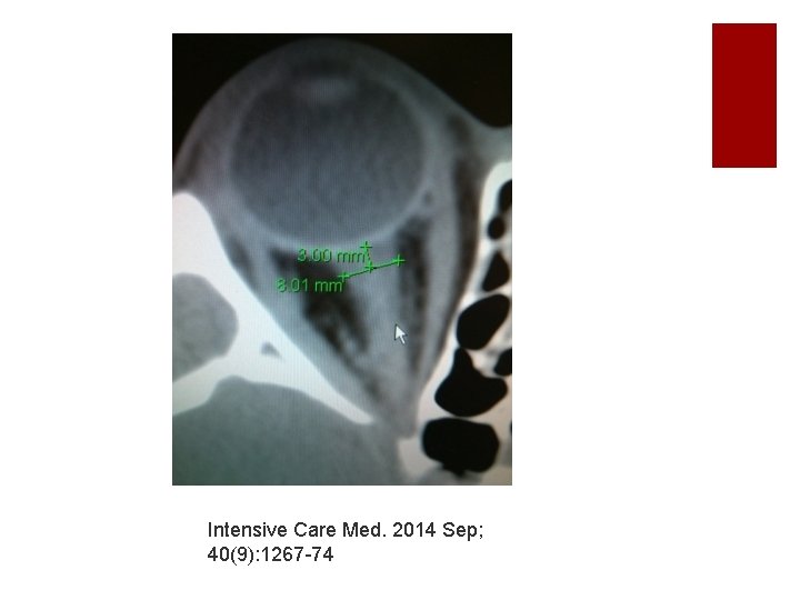Intensive Care Med. 2014 Sep; 40(9): 1267 -74 