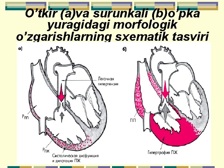 O’tkir (a)va surunkali (b)o’pka yuragidagi morfologik o’zgarishlarning sхematik tasviri 