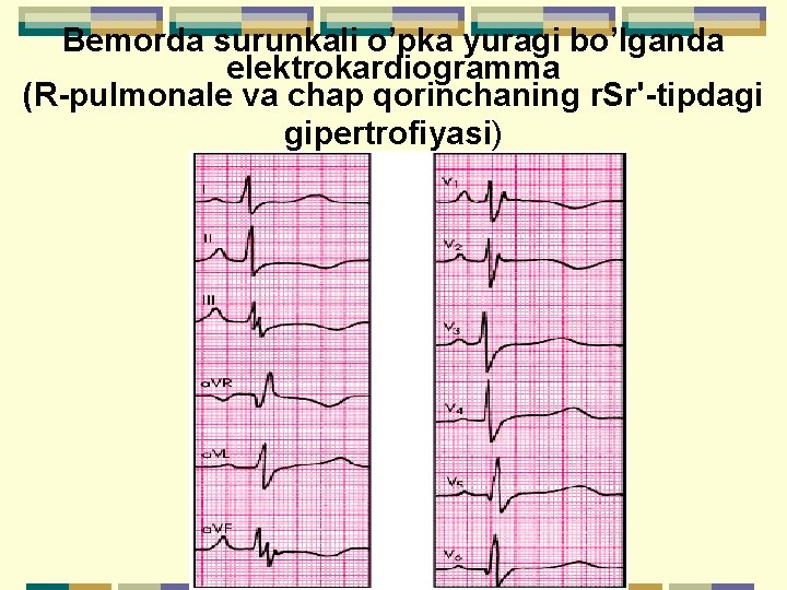 Bemorda surunkali o’pka yuragi bo’lganda elektrokardiogramma (R-pulmonale va chap qorinchaning r. Sr'-tipdagi gipertrofiyasi) 