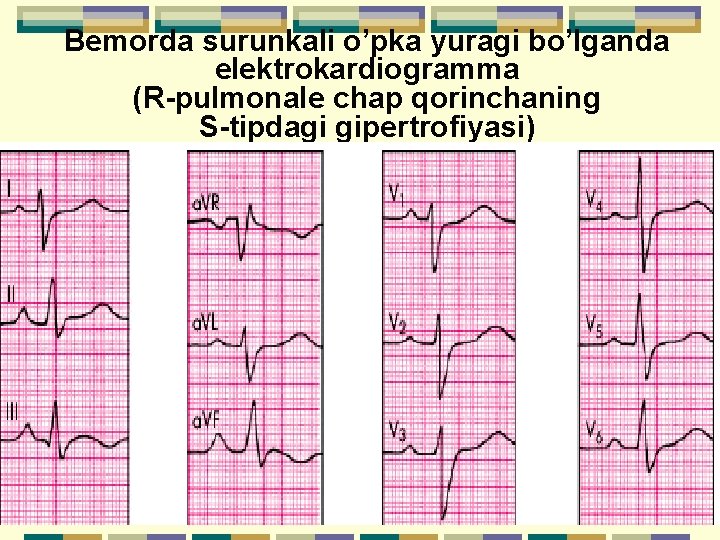 Bemorda surunkali o’pka yuragi bo’lganda elektrokardiogramma (R-pulmonale chap qorinchaning S-tipdagi gipertrofiyasi) 