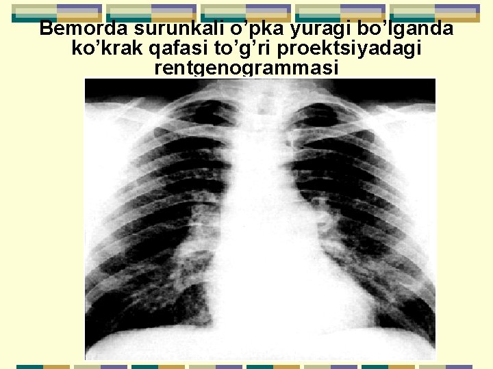 Bemorda surunkali o’pka yuragi bo’lganda ko’krak qafasi to’g’ri proektsiyadagi rentgenogrammasi 