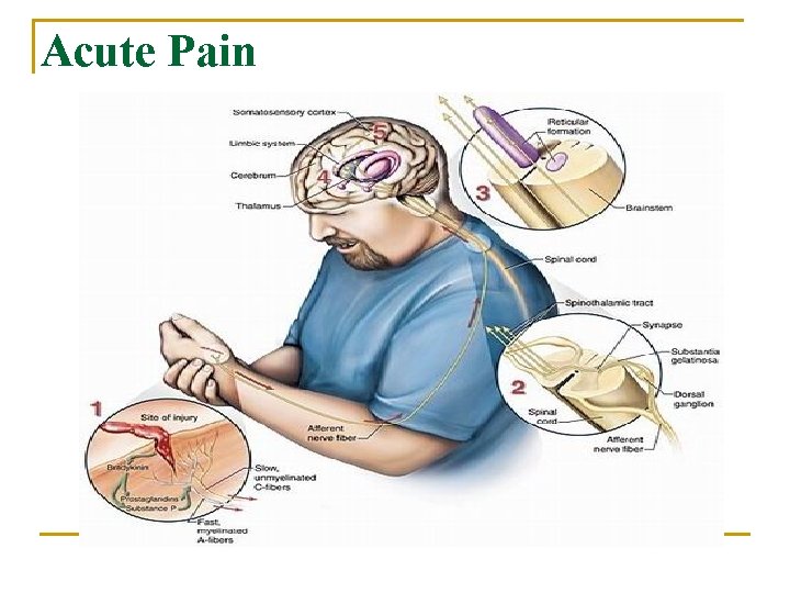 Acute Pain 