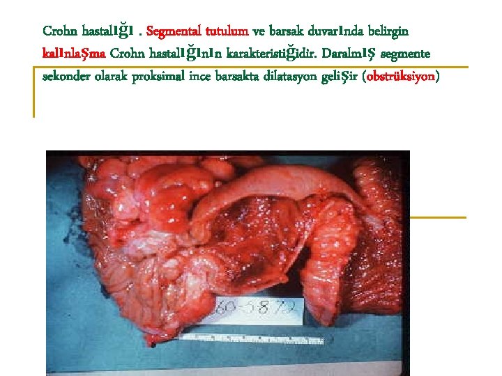 Crohn hastalığı. Segmental tutulum ve barsak duvarında belirgin kalınlaşma Crohn hastalığının karakteristiğidir. Daralmış segmente