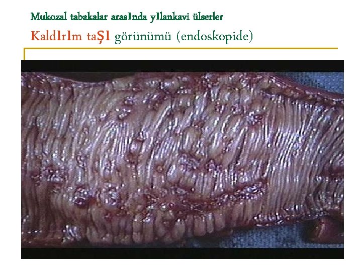 Mukozal tabakalar arasında yılankavi ülserler Kaldırım taşı görünümü (endoskopide) 