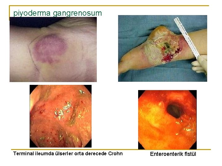 piyoderma gangrenosum Terminal ileumda ülserler orta derecede Crohn Enteroenterik fistül 