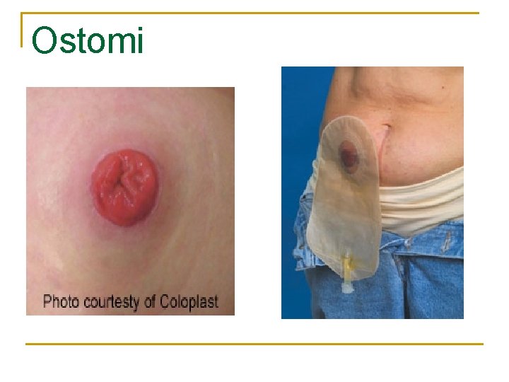 Ostomi 