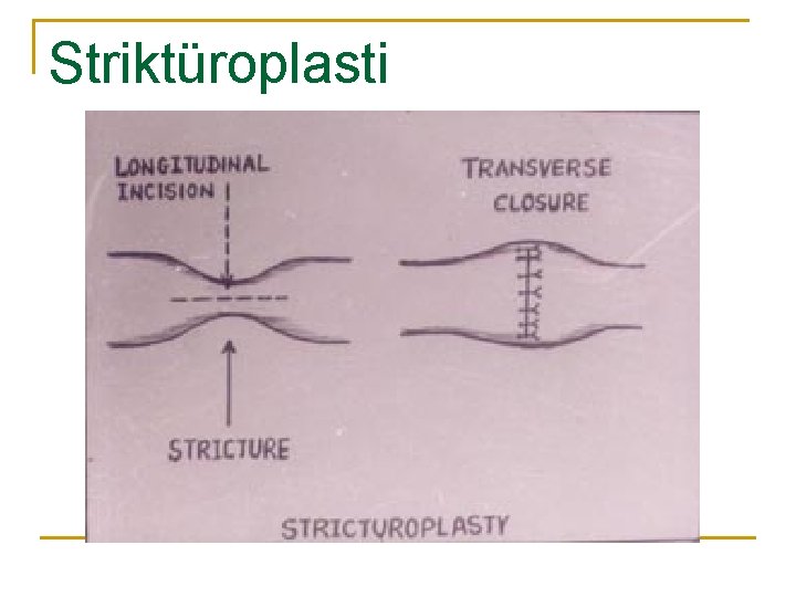 Striktüroplasti 