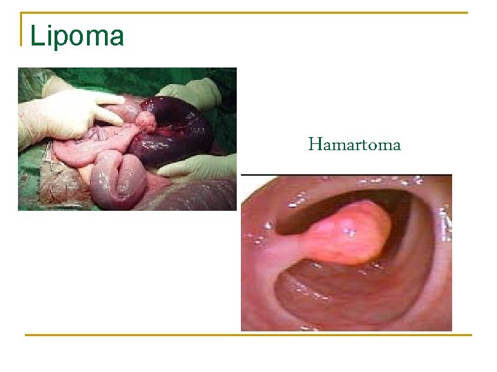 Lipoma Hamartoma 