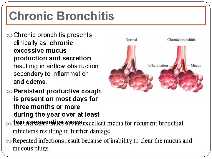 Chronic Bronchitis Chronic bronchitis presents clinically as: chronic excessive mucus production and secretion resulting