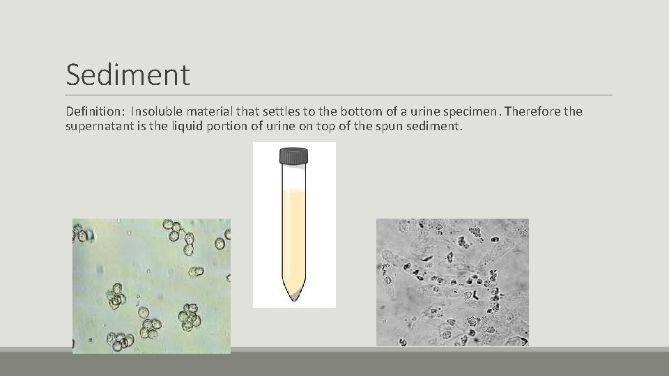 Sediment Definition: Insoluble material that settles to the bottom of a urine specimen. Therefore