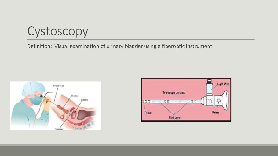 Cystoscopy Definition: Visual examination of urinary bladder using a fiberoptic instrument 