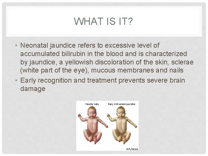 WHAT IS IT? • Neonatal jaundice refers to excessive level of accumulated bilirubin in