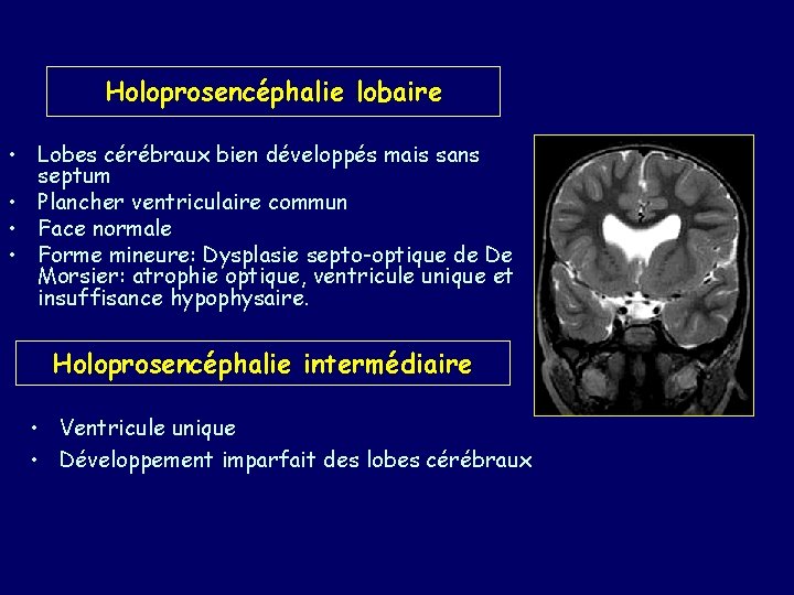 Holoprosencéphalie lobaire • Lobes cérébraux bien développés mais sans septum • Plancher ventriculaire commun