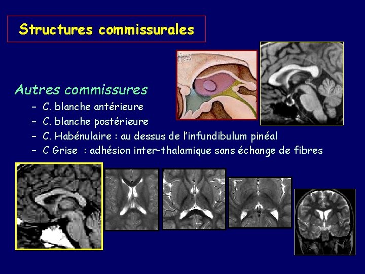 Structures commissurales Autres commissures – – C. blanche antérieure C. blanche postérieure C. Habénulaire