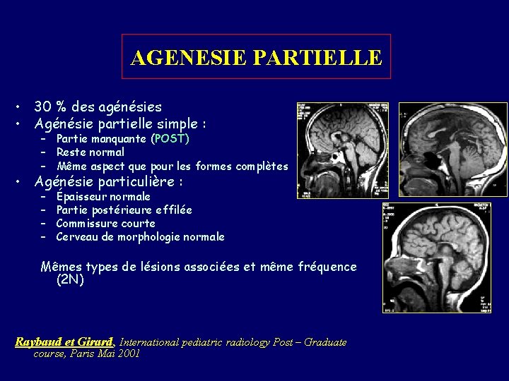 AGENESIE PARTIELLE • 30 % des agénésies • Agénésie partielle simple : – Partie