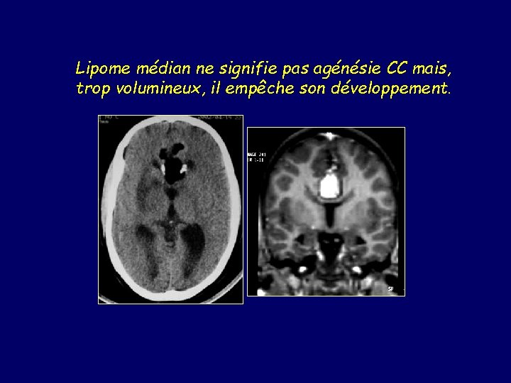 Lipome médian ne signifie pas agénésie CC mais, trop volumineux, il empêche son développement.