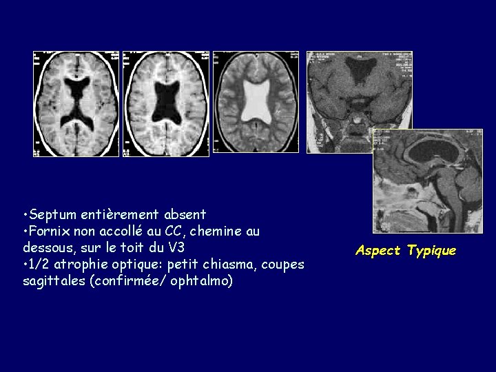  • Septum entièrement absent • Fornix non accollé au CC, chemine au dessous,