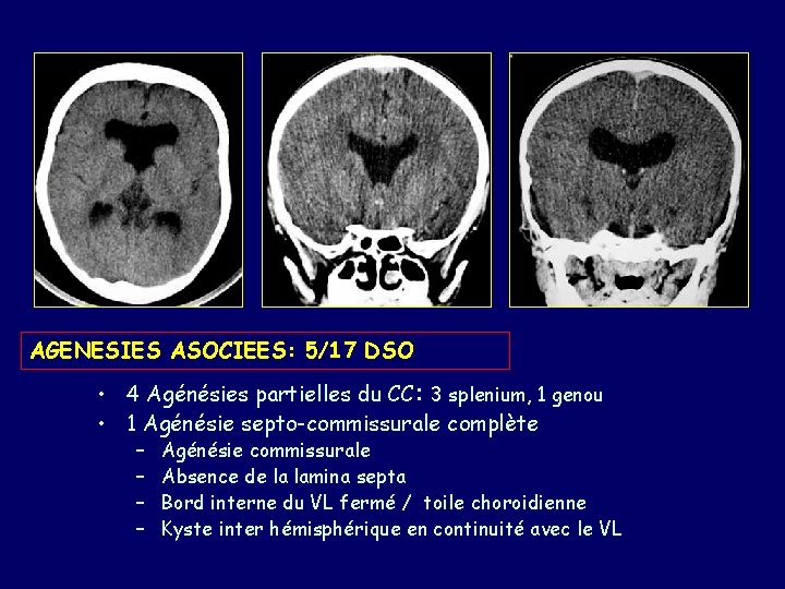 AGENESIES ASOCIEES: 5/17 DSO • 4 Agénésies partielles du CC: 3 splenium, 1 genou