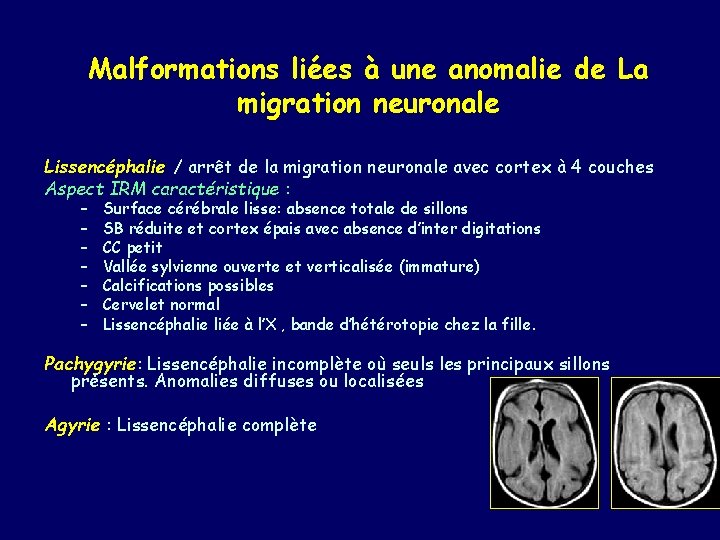 Malformations liées à une anomalie de La migration neuronale Lissencéphalie / arrêt de la