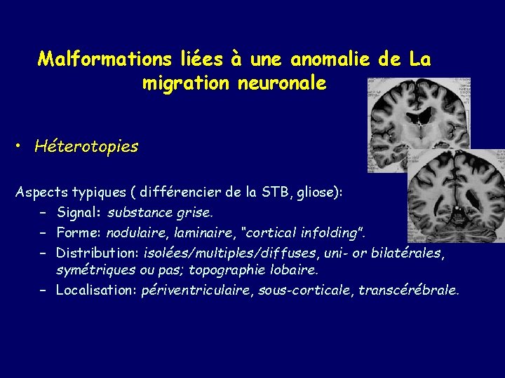 Malformations liées à une anomalie de La migration neuronale • Héterotopies Aspects typiques (