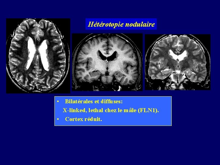 Hétérotopie nodulaire • Bilatérales et diffuses: X-linked, lethal chez le mâle (FLN 1). •