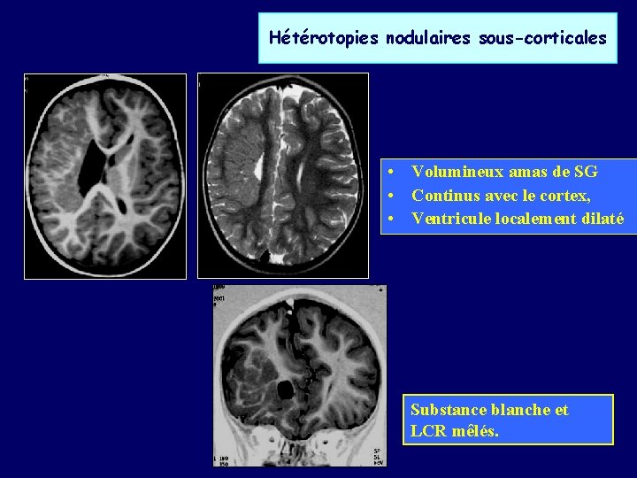 Hétérotopies nodulaires sous-corticales • Volumineux amas de SG • Continus avec le cortex, •