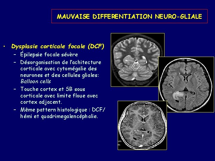 MAUVAISE DIFFERENTIATION NEURO-GLIALE • Dysplasie corticale focale (DCF) – Épilepsie focale sévère – Désorganisation