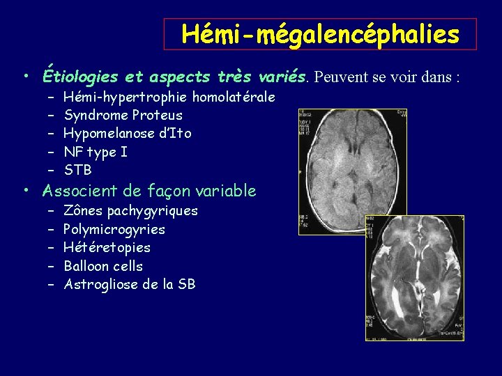Hémi-mégalencéphalies • Étiologies et aspects très variés. Peuvent se voir dans : – –