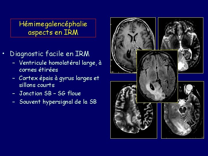 Hémimegalencéphalie aspects en IRM • Diagnostic facile en IRM – Ventricule homolatéral large, à