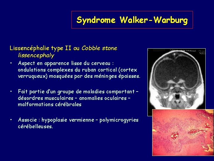 Syndrome Walker-Warburg Lissencéphalie type II ou Cobble stone lissencephaly • Aspect en apparence lisse