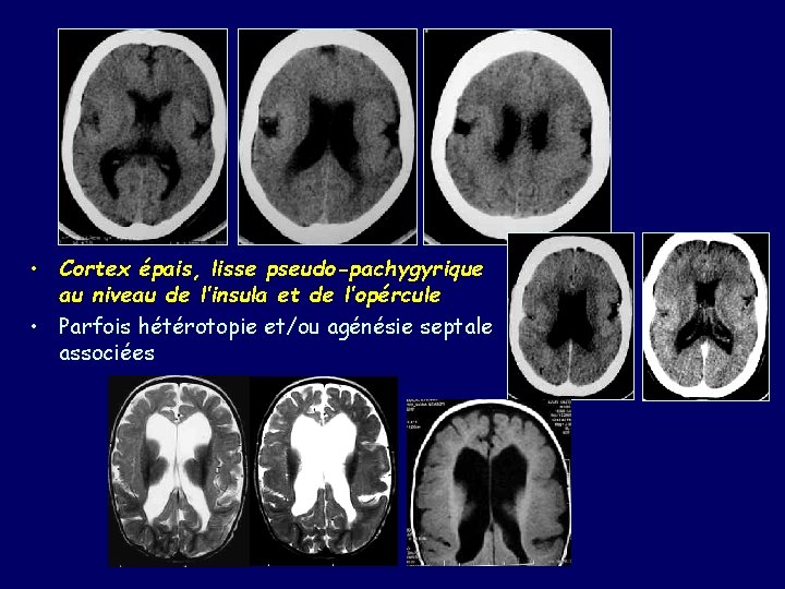  • Cortex épais, lisse pseudo-pachygyrique au niveau de l’insula et de l’opércule •