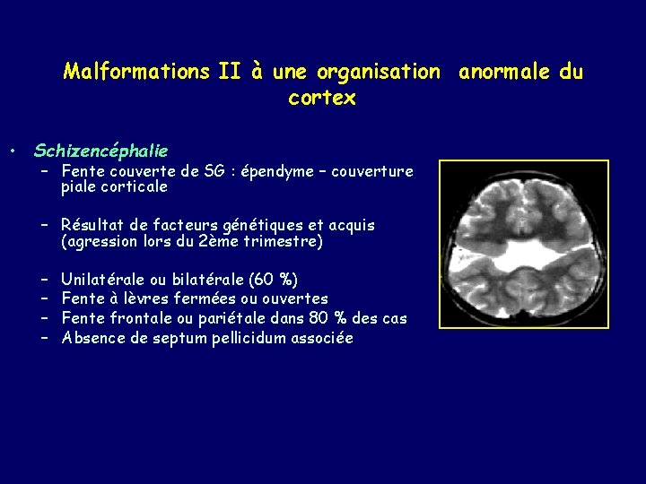 Malformations II à une organisation anormale du cortex • Schizencéphalie – Fente couverte de