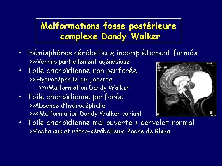 Malformations fosse postérieure complexe Dandy Walker • Hémisphères cérébelleux incomplètement formés >>>Vermis partiellement agénésique