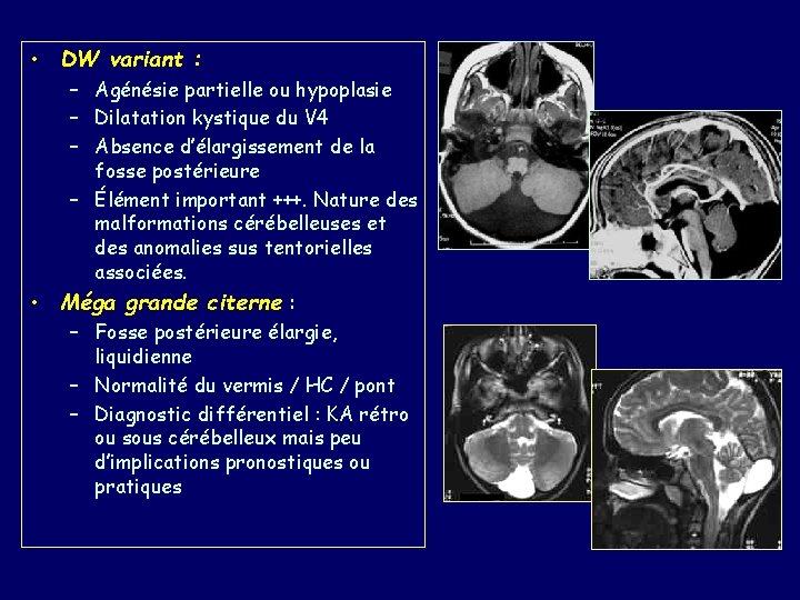  • DW variant : – Agénésie partielle ou hypoplasie – Dilatation kystique du