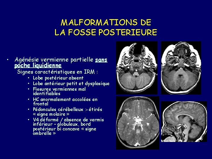 MALFORMATIONS DE LA FOSSE POSTERIEURE • Agénésie vermienne partielle sans poche liquidienne Signes caractéristiques