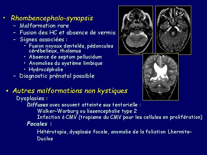  • Rhombencephalo-synapsis – Malformation rare – Fusion des HC et absence de vermis