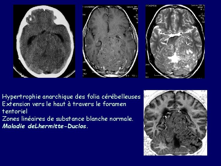 Hypertrophie anarchique des folia cérébelleuses Extension vers le haut à travers le foramen tentoriel