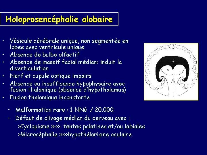Holoprosencéphalie alobaire • Vésicule cérébrale unique, non segmentée en lobes avec ventricule unique •